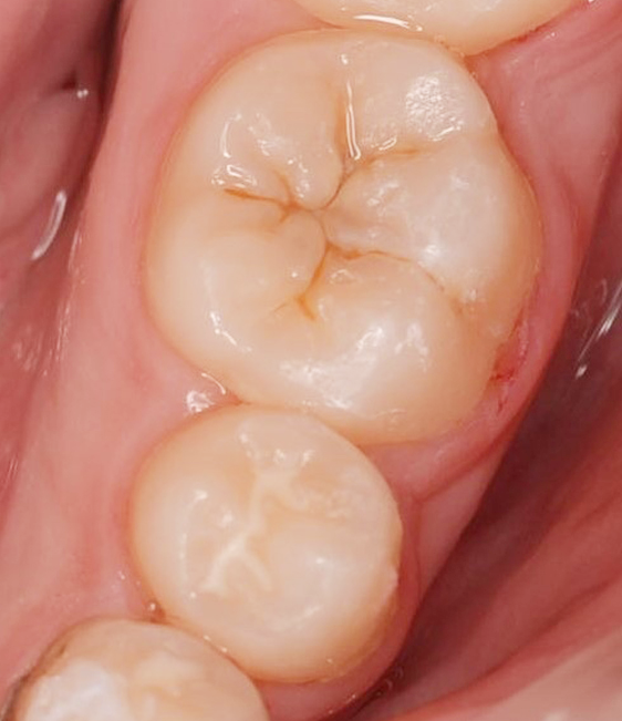 シーラント処置前の歯の写真