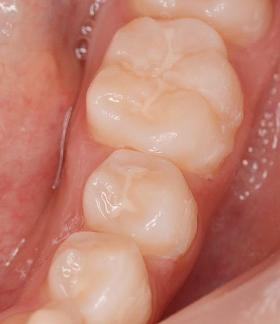白シーラント処置後の歯の写真