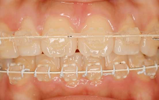 ホワイトワイヤー写真