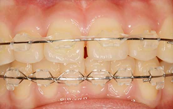 透明ブラケット装置写真