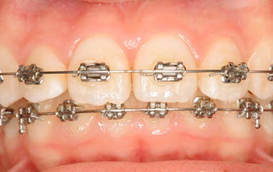 金属(シルバー)ブラケット装置写真