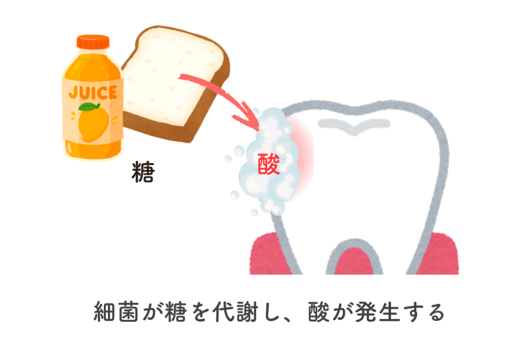 むし歯のでき方イメージイラスト