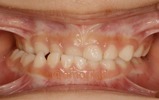 交叉咬合症例写真