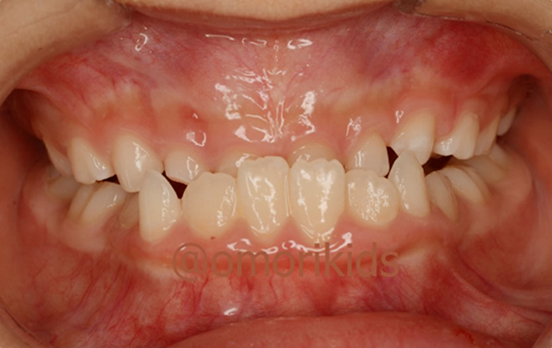 反対咬合の症例写真