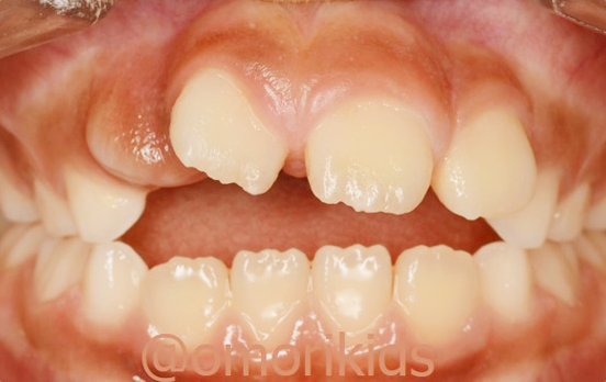 開咬の症例写真