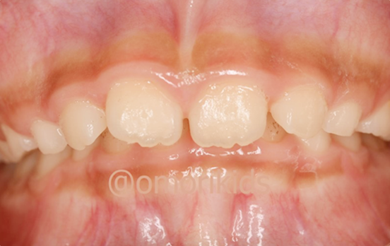 過蓋咬口の症例写真