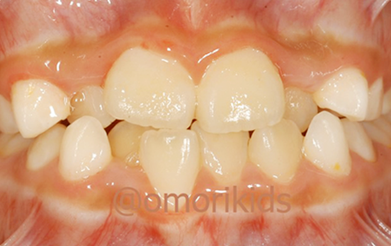 叢生の症例写真