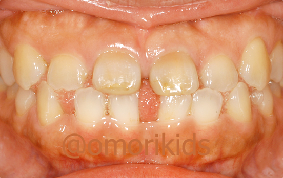 空隙歯列の症例写真