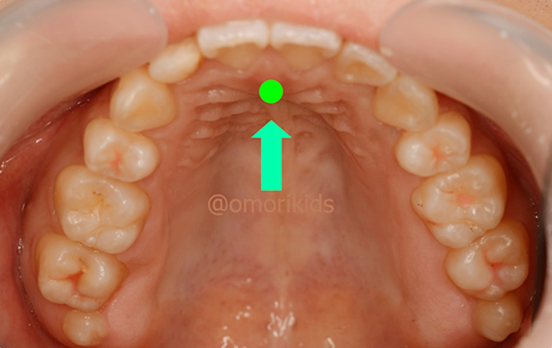 舌と顎の案静位写真
