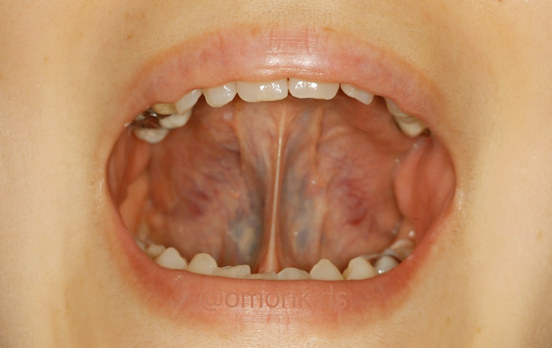 ベロを上あごに張り付ける写真