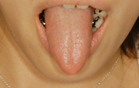 舌を細くするとレーニング写真